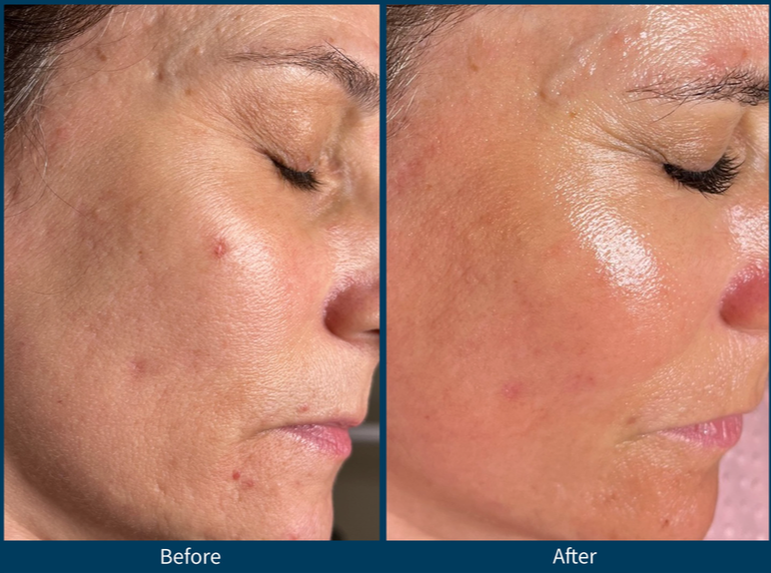 Rejuvaskin™ Silicone Scar Cream