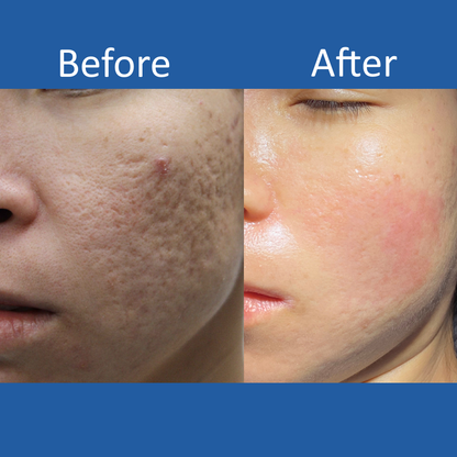 Rejuvaskin™ Silicone Scar Cream